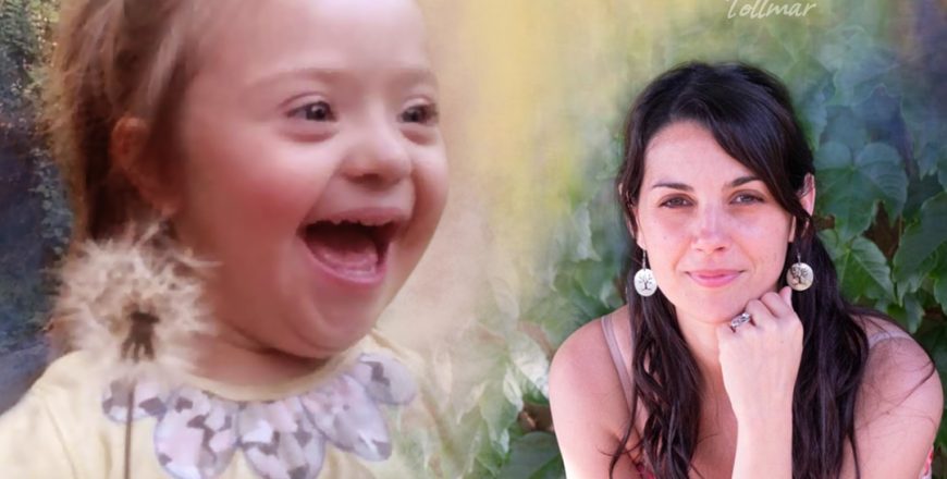 44-sindrome de down